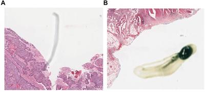 Deep learning-based identification of esophageal cancer subtypes through analysis of high-resolution histopathology images